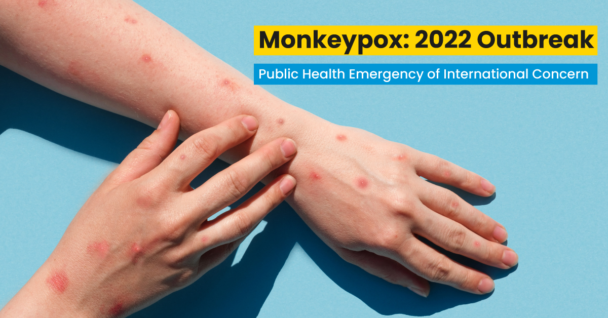 Monkeypox: 2022 Outbreak