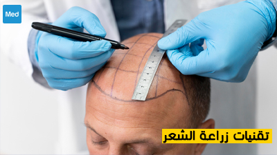 تقنيات زراعة الشعر 